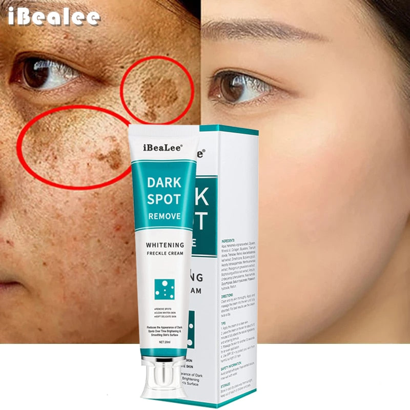 iBeaLee Whitening Freckle Cream Remove Melasma Cream Remove Dark Spots Melanin Melasma Remover Brighten Skin Anti-Aging